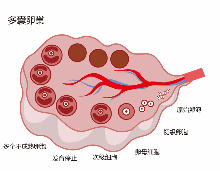 多囊卵巢和卵巢早衰有什么区别？