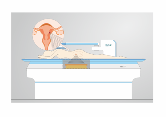 聚焦超声消融治疗子宫肌瘤后会缩小吗？