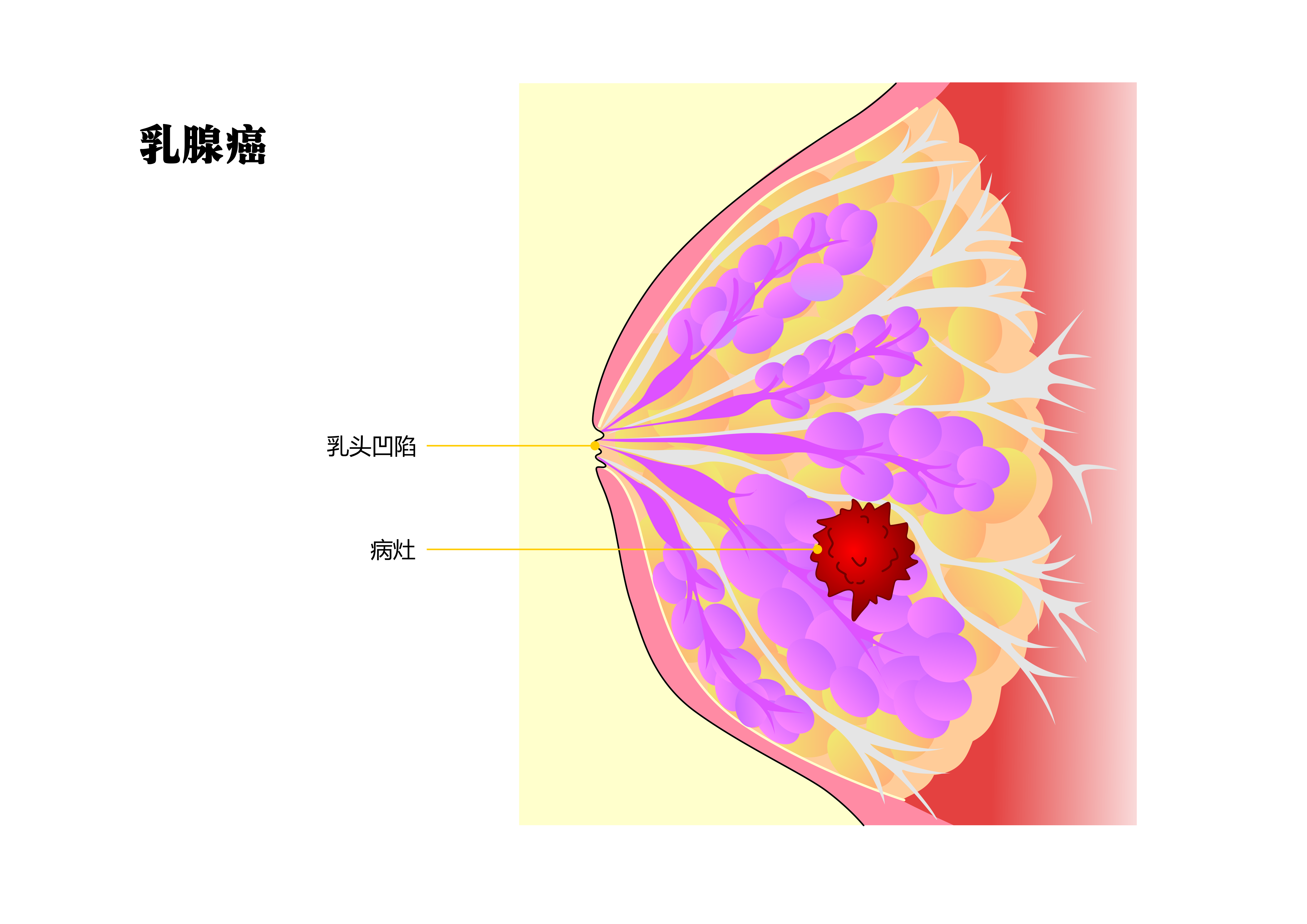 乳腺癌是气出来的吗？