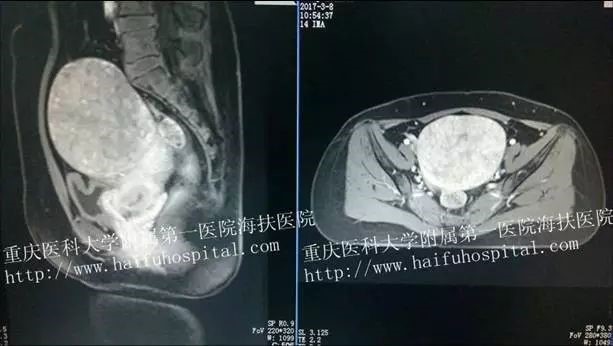 从非洲到重庆：她战胜了10cm大肌瘤！