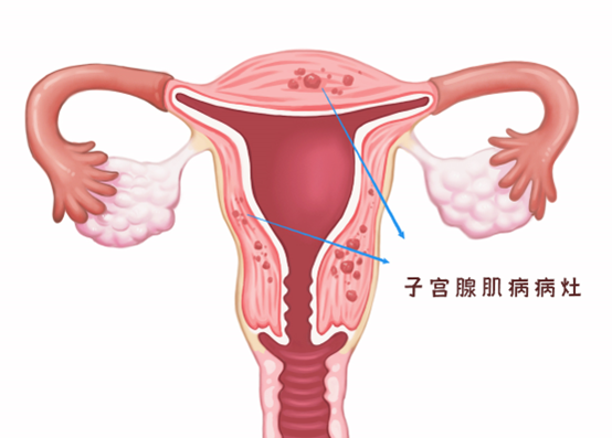 子宫腺肌病治疗相关问题