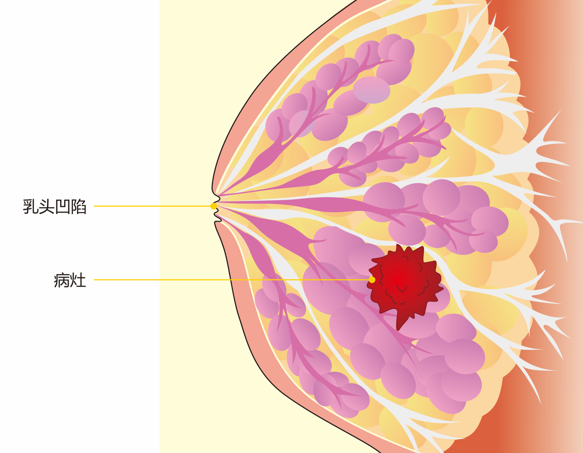 乳腺癌的早期症状有哪些？