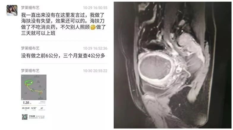 选择聚焦超声消融手术，是不会失望的