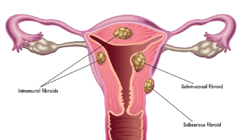 子宫肌瘤怎么才能治好，这种方法你知道吗？