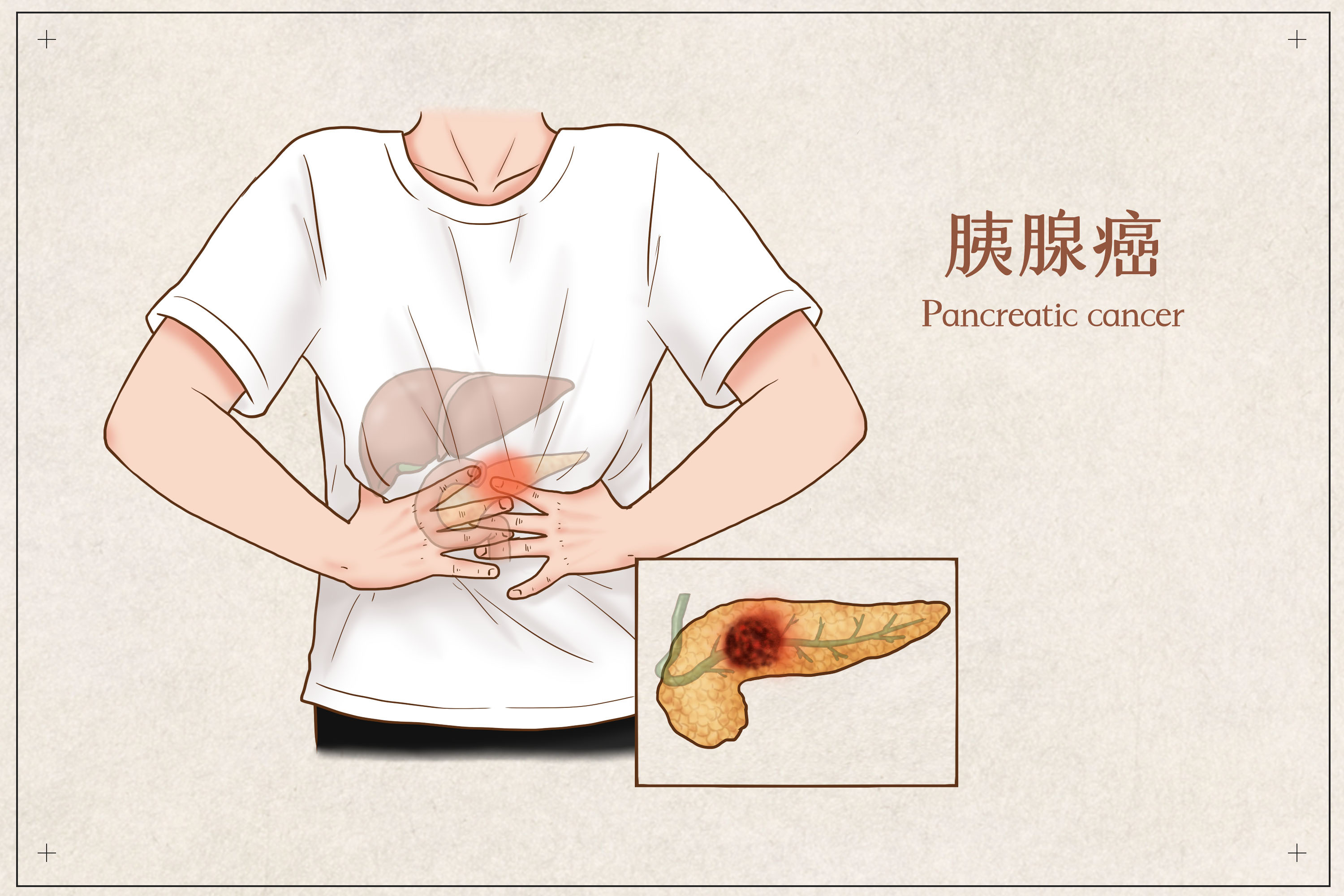 生存率仅为5%的胰腺癌患者，为什么治疗那么难？