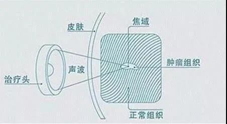 聚焦超声消融手术治疗子宫肌瘤有哪些优势