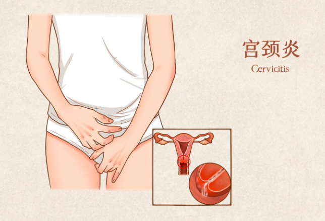 慢性宫颈炎对怀孕有影响吗？