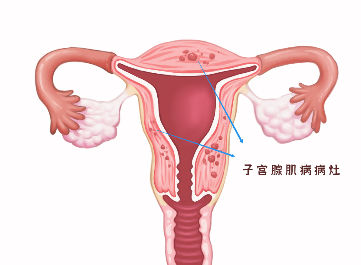 子宫腺肌瘤与子宫肌瘤有什么区别？