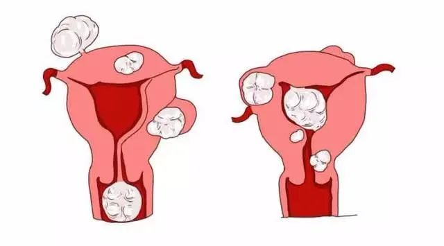 吉林省子宫肌瘤手术哪家好