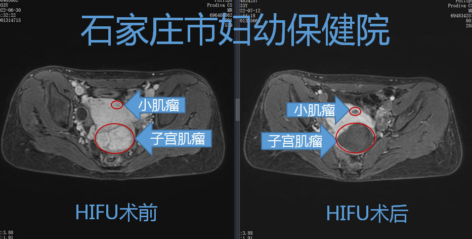 一次胎停，一次生化，两次异位妊娠，海扶后终圆妈妈梦