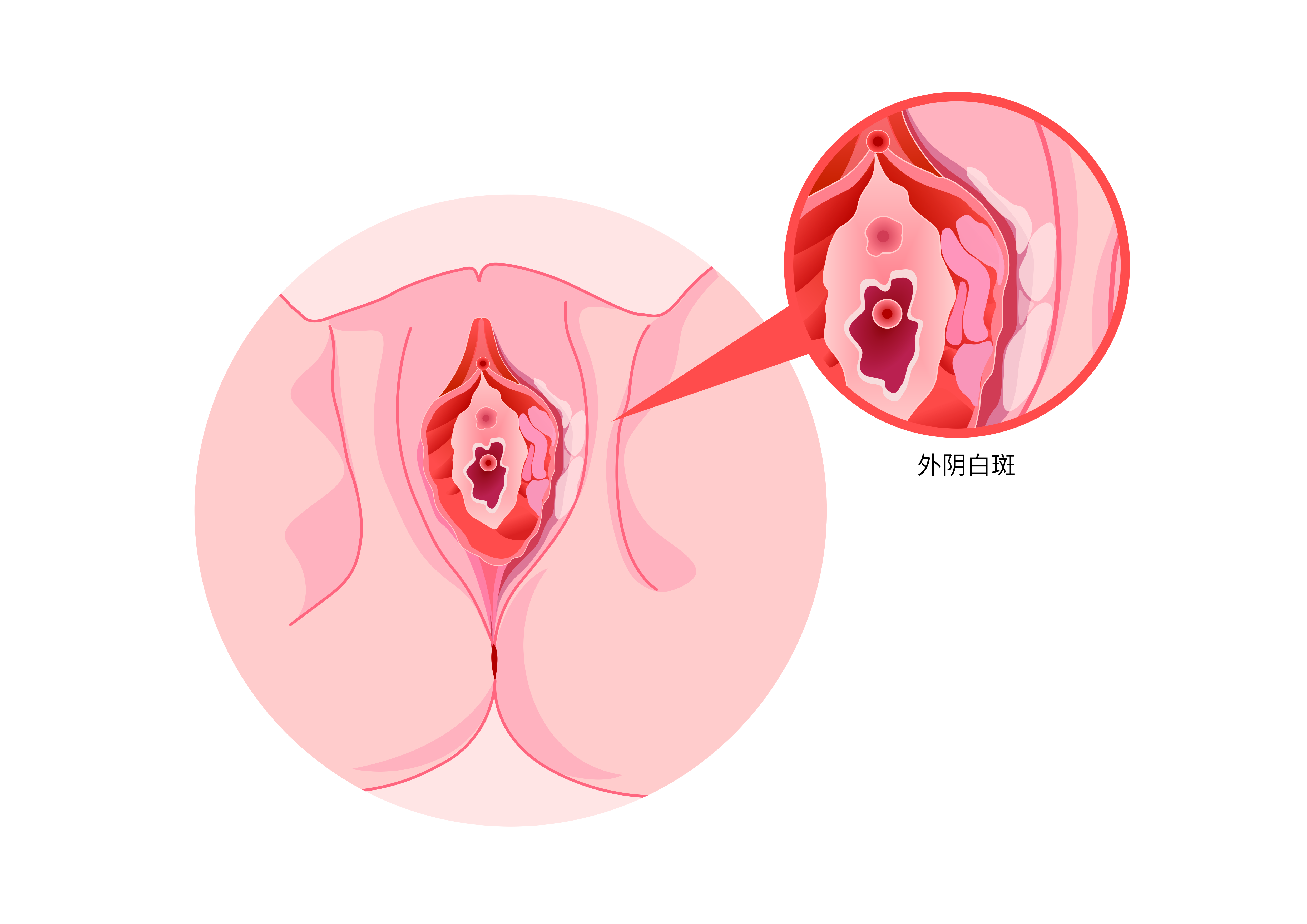 外阴白斑会遗传吗