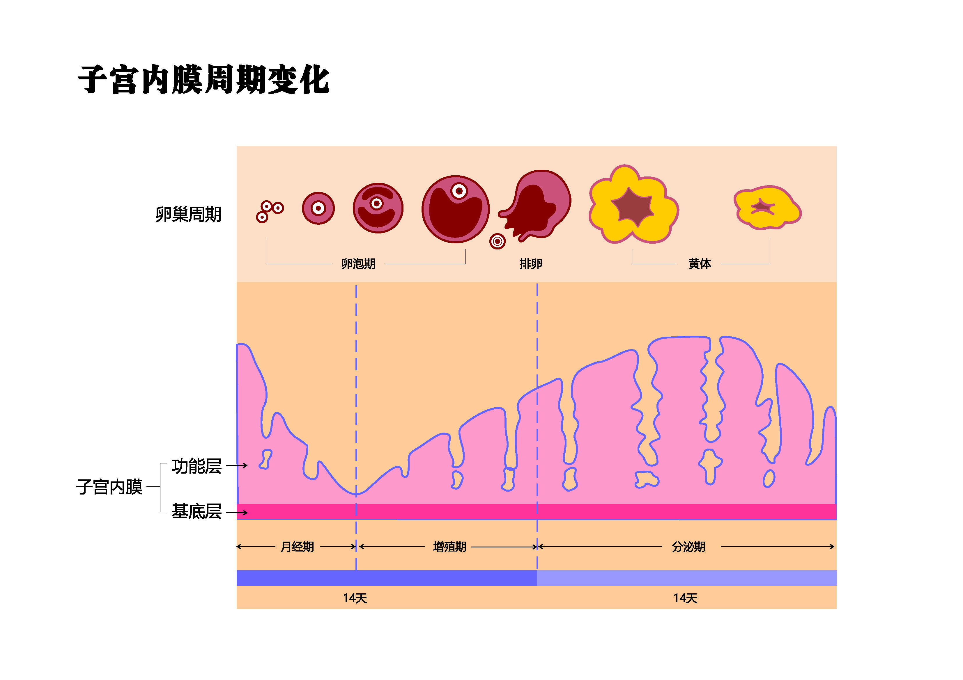 子宫内膜炎是怎么导致的？