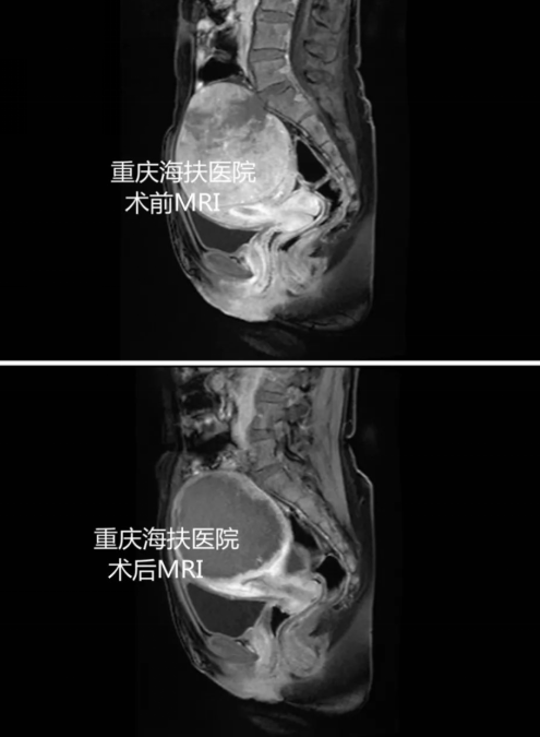 患者故事|得知患巨大子宫肌瘤后，从寝食不安到如释重负