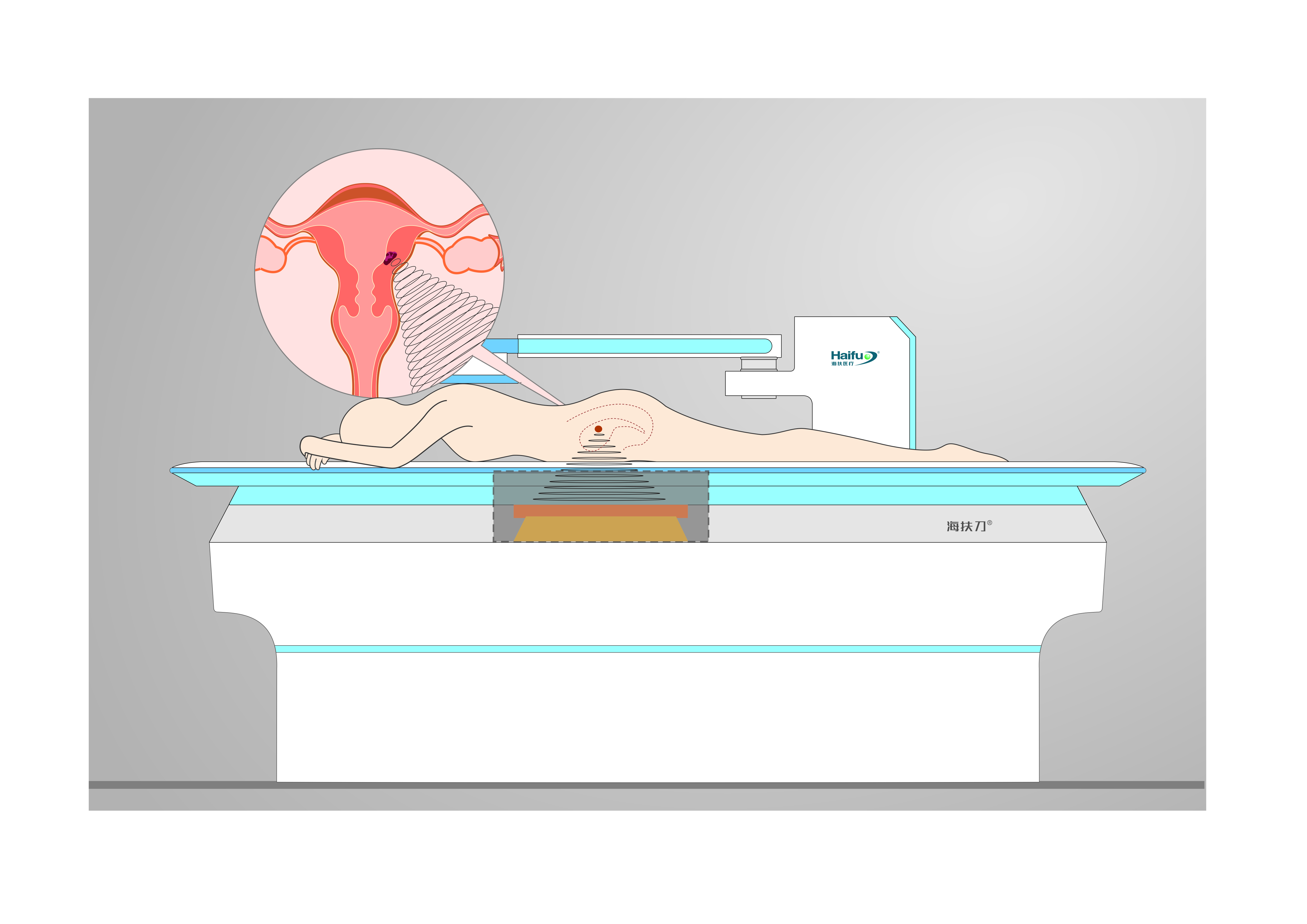 聚焦超声消融手术治疗子宫肌瘤，为什么不会影响生育