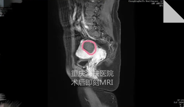 典型案例|看图说话，子宫肌瘤聚焦超声消融术后半年缩小78%