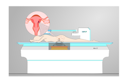 子宫肌瘤微波消融和聚焦超声消融有什么区别？