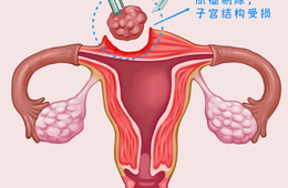 杭州子宫肌瘤手术费用详细解析