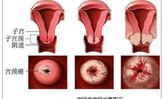 宫颈癌筛查是做什么，需要月经干净后吗？