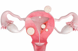 女性绝经后，子宫肌瘤会自然缩小吗？