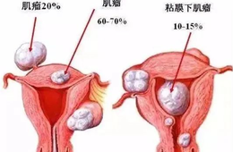 子宫肌瘤多大需要手术？