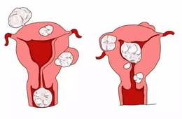 蛋白粉对子宫肌瘤有何影响？