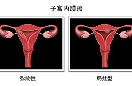 子宫内膜癌早期两大症状，助你及时发现病变！