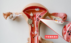 子宫腺肌病患者警惕：这三种情况，尽快就医！