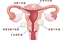 什么样的子宫肌瘤可以自己摸出来？