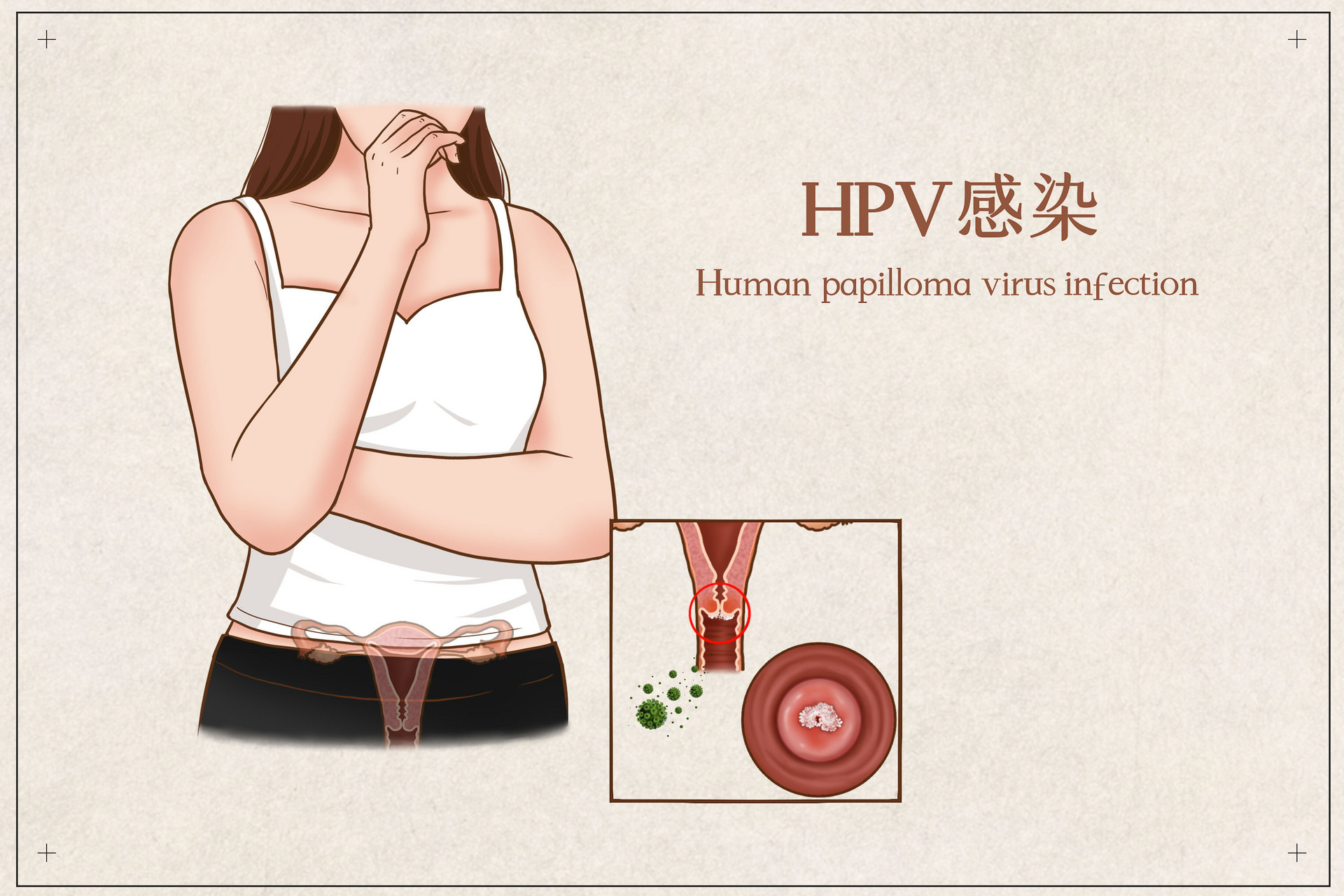 HPV感染后的疫苗接种还有意义吗？