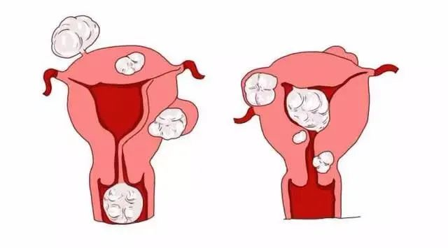 女人不能忽视的一种常见病——子宫肌瘤
