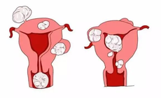 女人不能忽视的一种常见病——子宫肌瘤