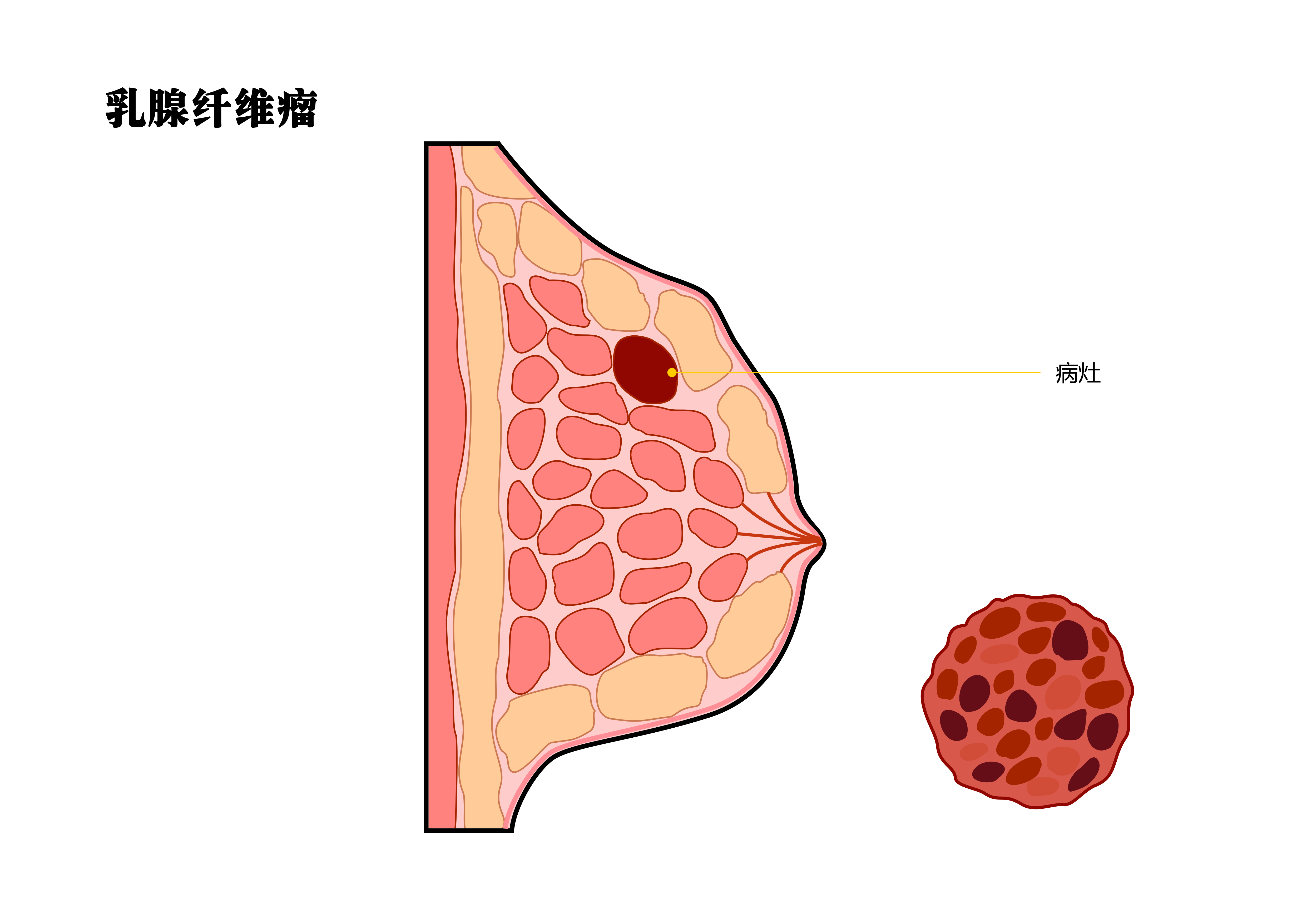 乳腺纤维瘤在年轻女性中为何如此高发？