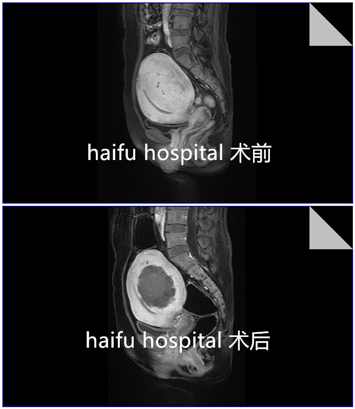 痛经12年，中度贫血，子宫增大如怀孕5月，她的保宫之路如何开启