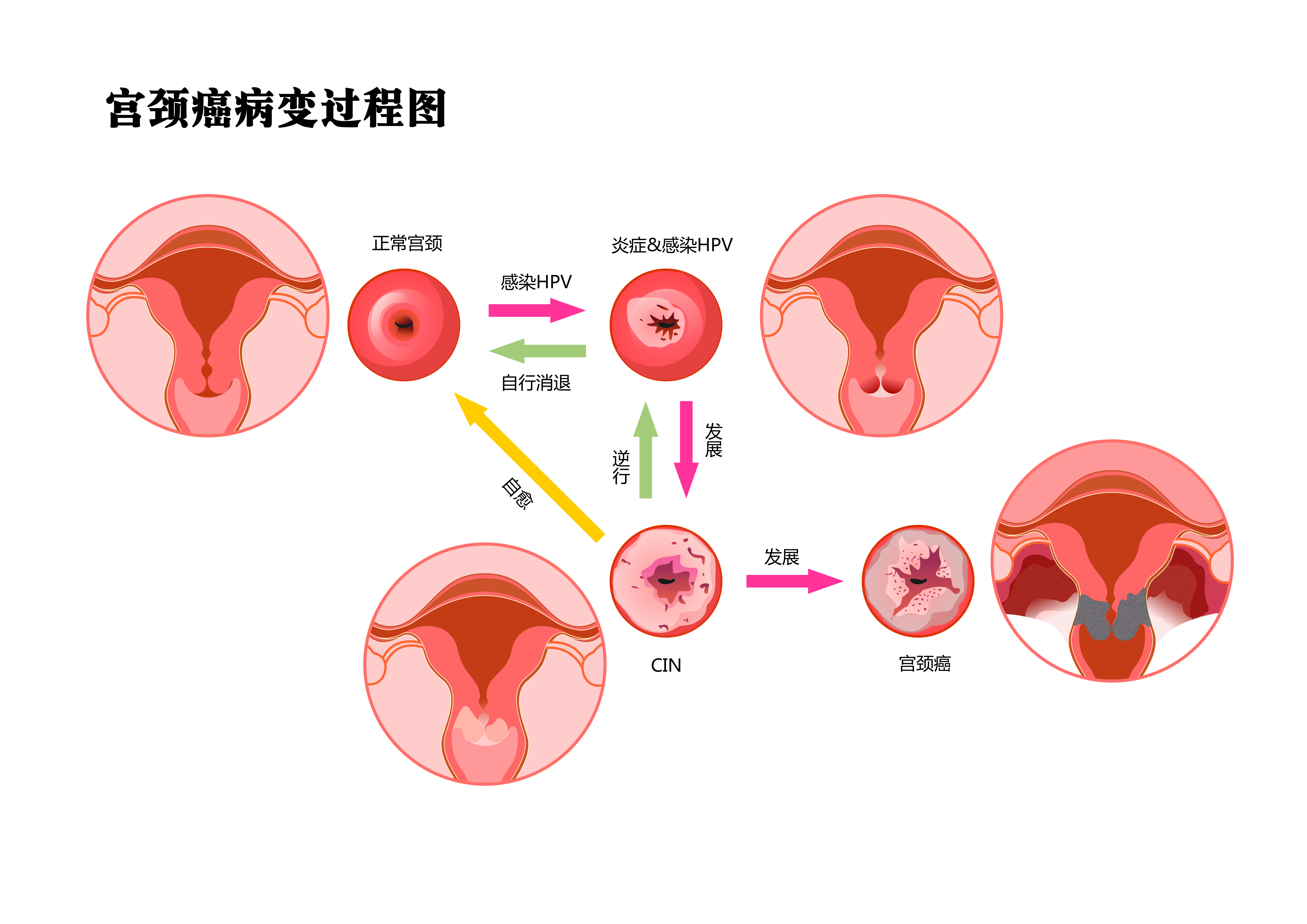 “宫颈癌”一发现就是晚期？很多人都是忽视了这些症状