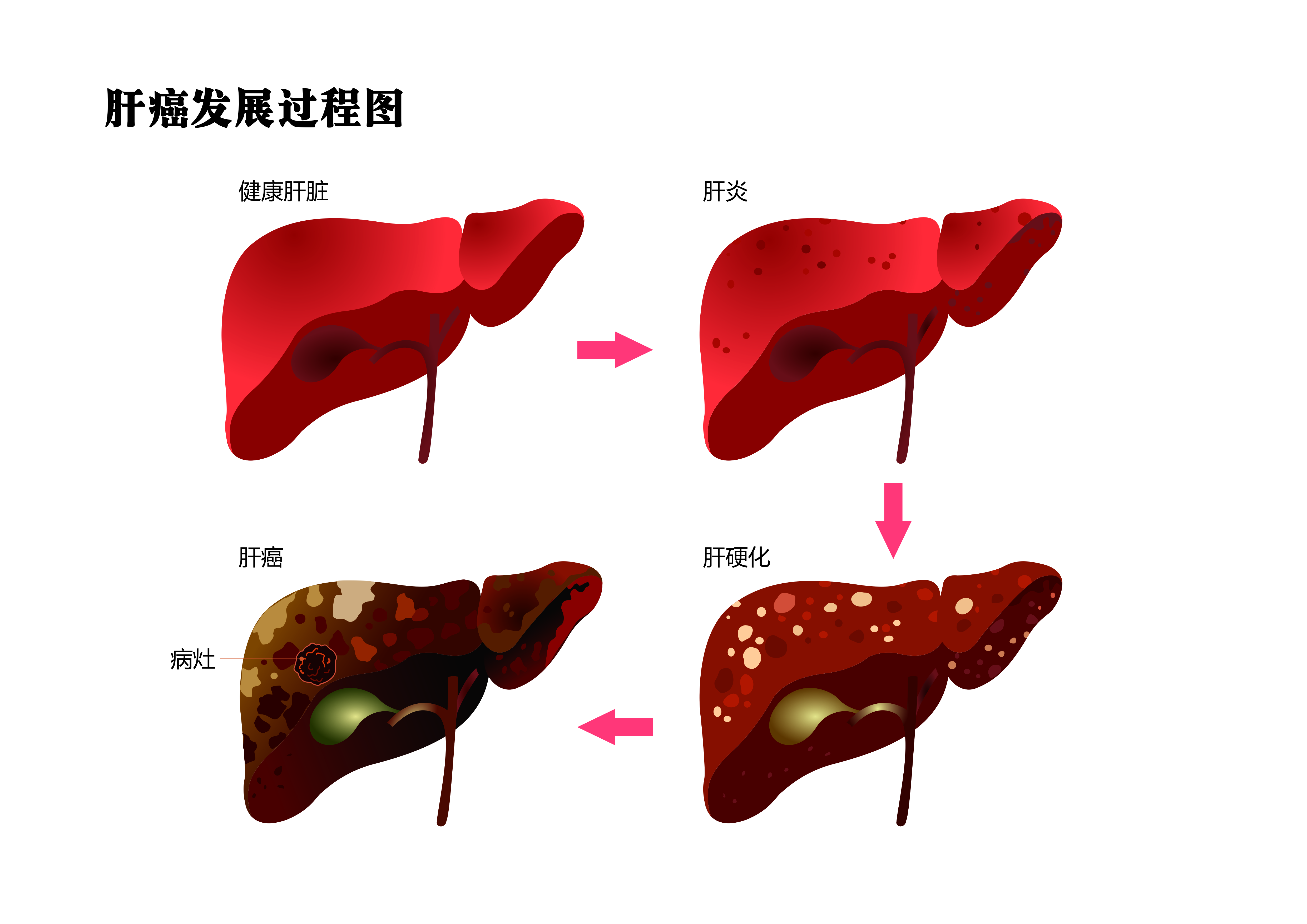 肝癌背后的推手、早期症状及预防