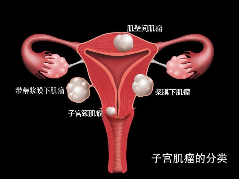 无任何症状，女子被确诊为子宫肌瘤