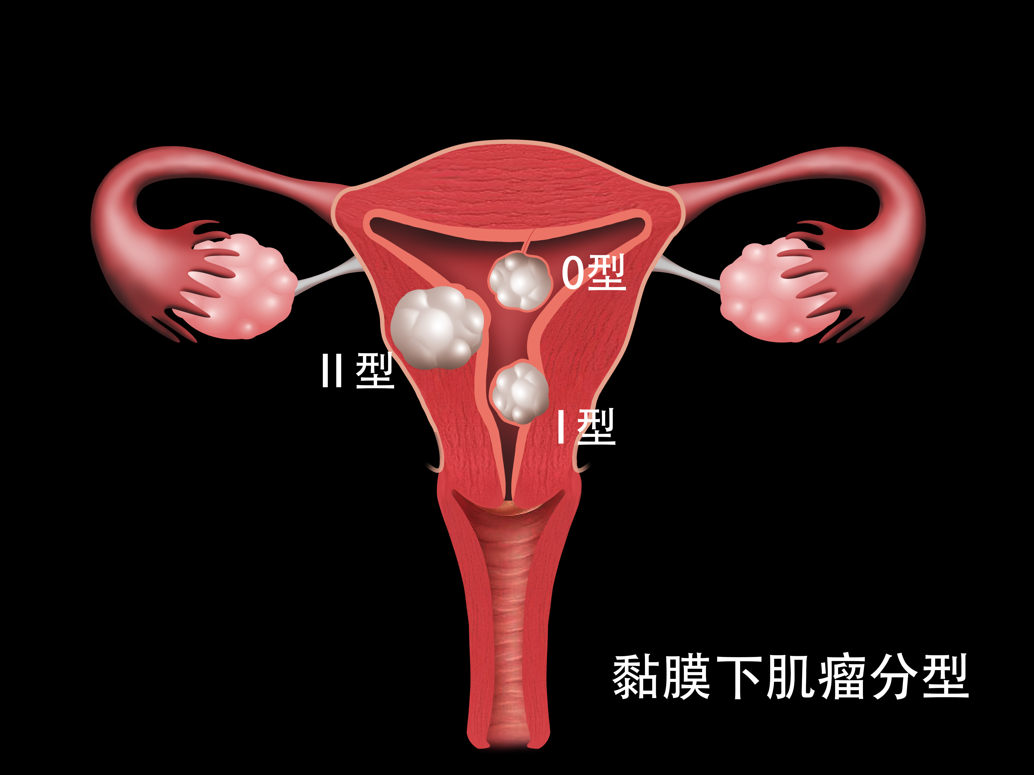 子宫肌瘤偏爱这4类女性，出现这4个信号要警惕！