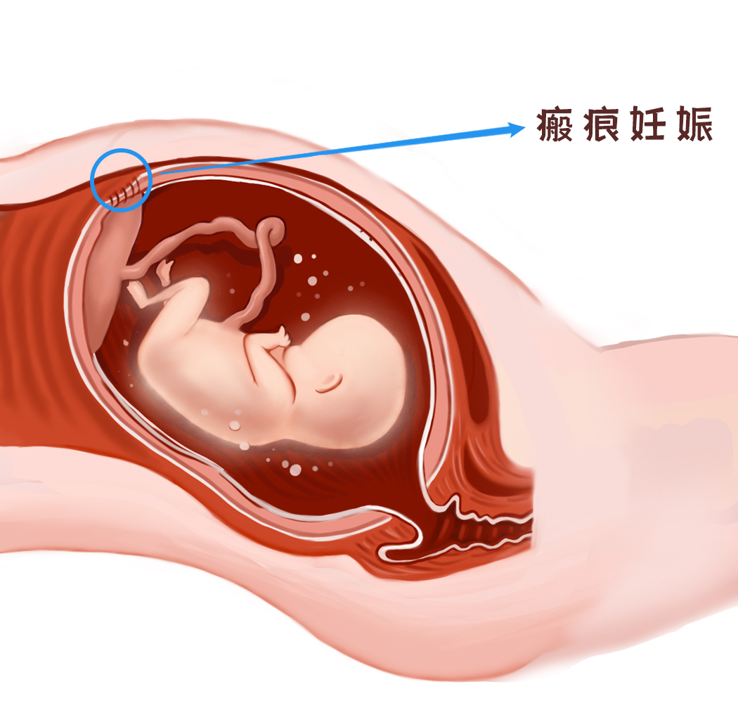 瘢痕妊娠有多危险？