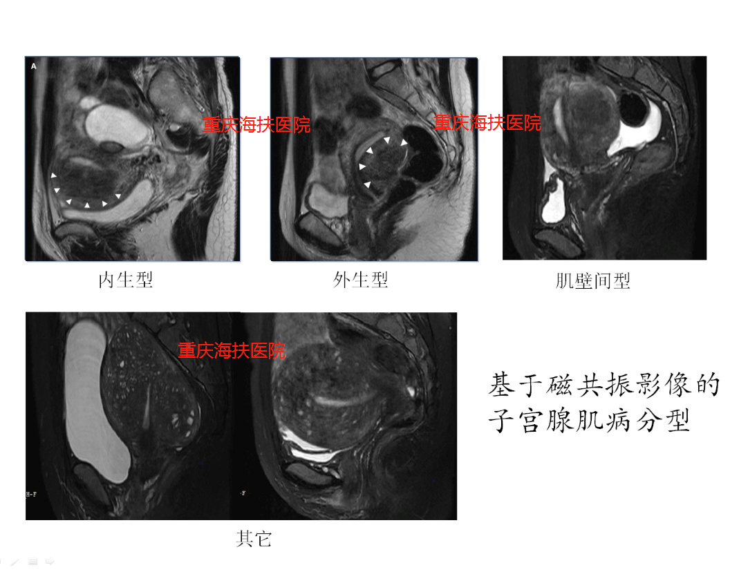 子宫腺肌病新分型，都分哪几种？