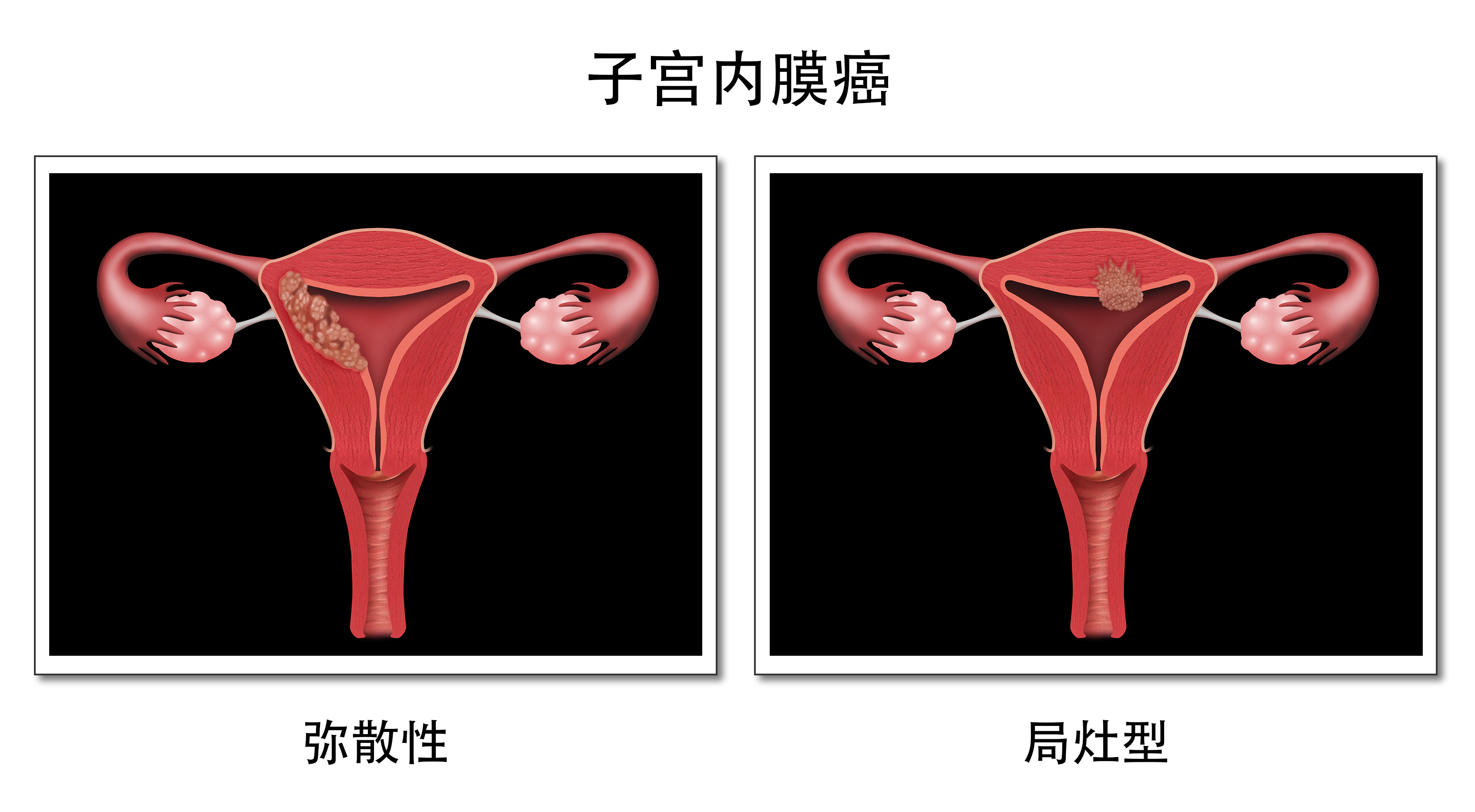 这些人群，要担心子宫内膜癌找上你