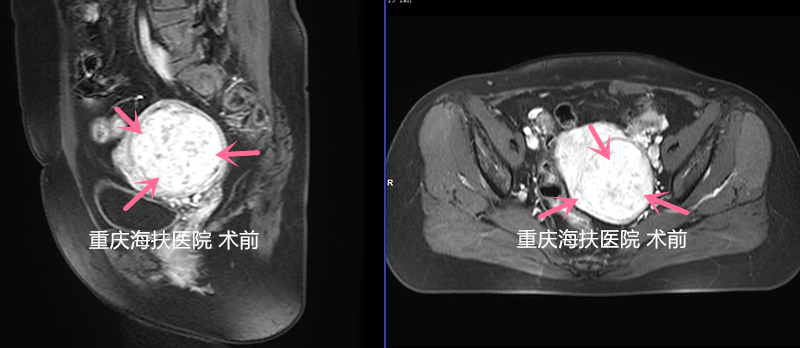 后壁肌瘤，血供丰富，剖宫产瘢痕，也能做聚焦超声消融吗？