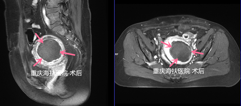 后壁肌瘤，血供丰富，剖宫产瘢痕，也能做聚焦超声消融吗？