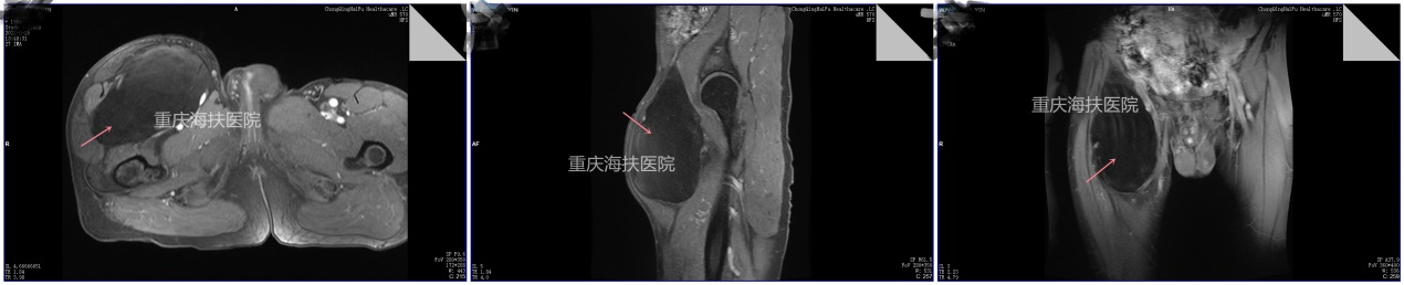 ​巨大脂肪瘤（16cm*30cm）是如何不开刀就解决的？