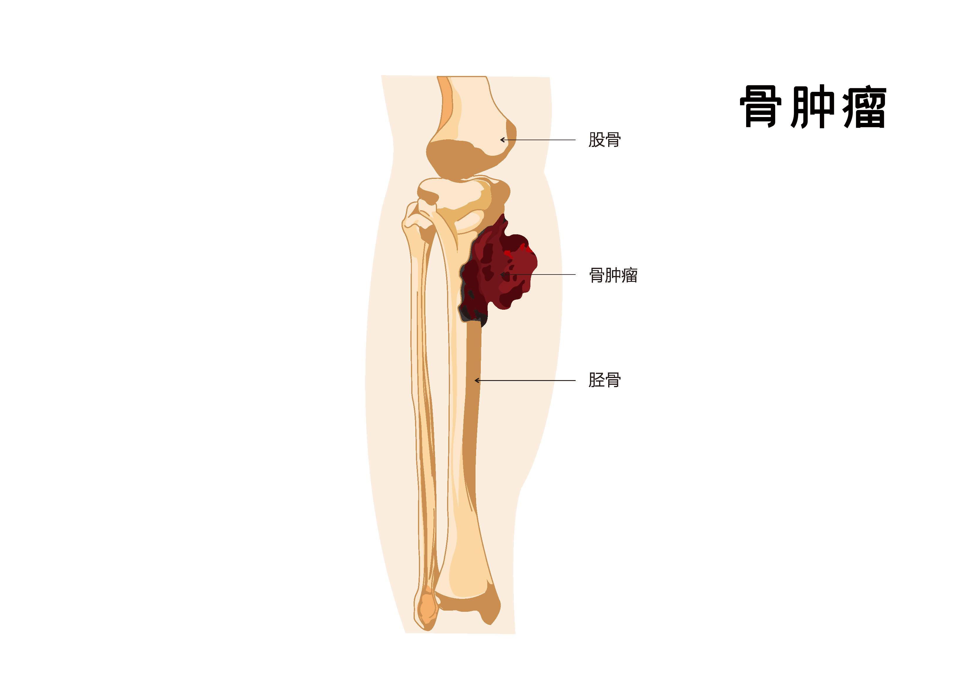 骨肉瘤来袭，难道注定“断腿”人生？别慌，现代医学有话说！