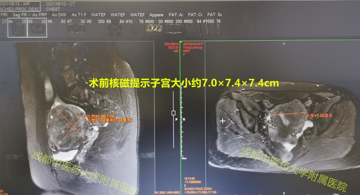 忍痛十年医生还建议切除子宫，非要抗争到底