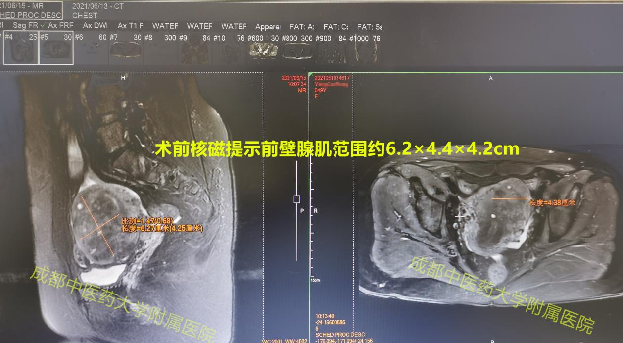 忍痛十年医生还建议切除子宫，非要抗争到底