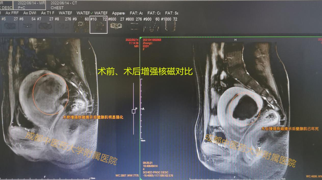 33岁的她不愿切除子宫，成都中医药大学附属医院无创解决痛经问题