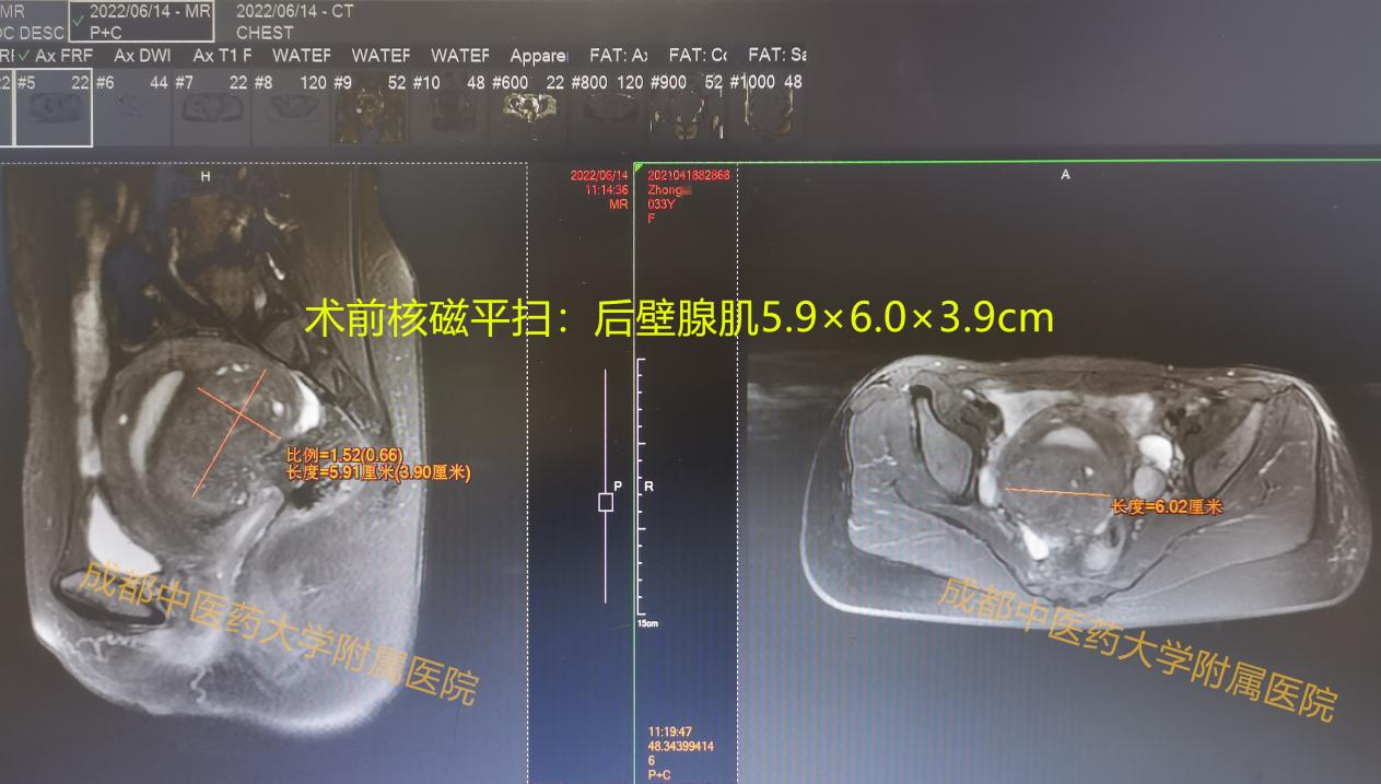 33岁的她不愿切除子宫，成都中医药大学附属医院无创解决痛经问题