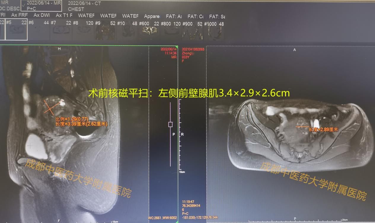 33岁的她不愿切除子宫，成都中医药大学附属医院无创解决痛经问题