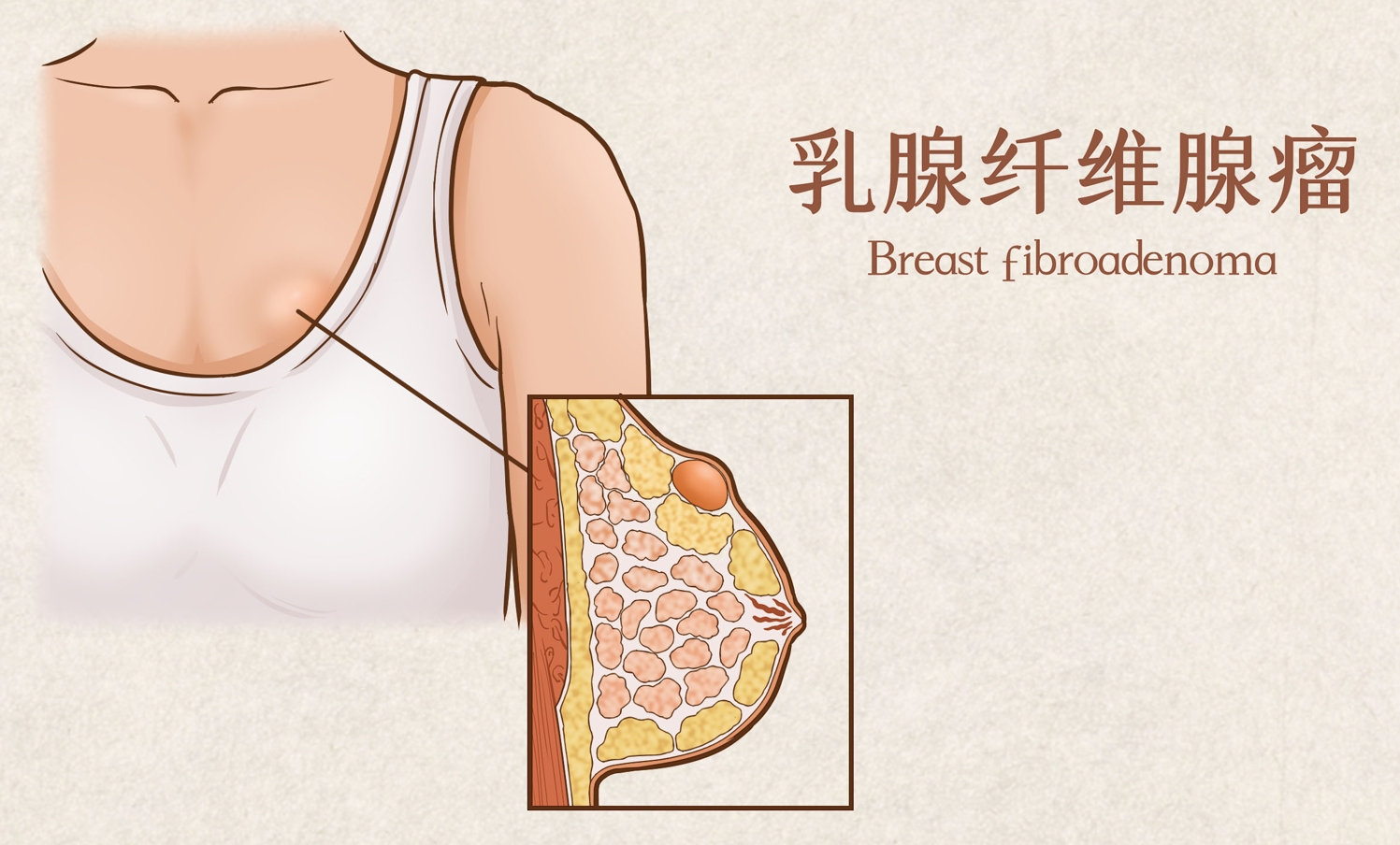 乳腺纤维瘤是种什么疾病？